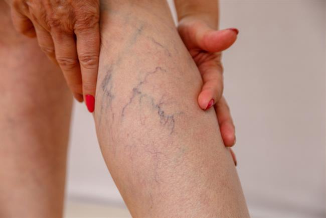 Premagajte težave z ožiljem s kompresijskimi nogavicami . (Foto: Freepik.com)