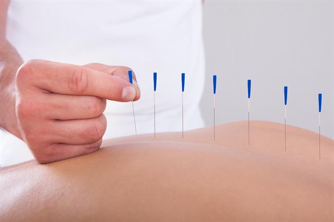 Akupunktura je tisočletja stara kitajska metoda zdravljenja.  (foto: Thermana)