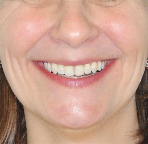 Vse več odraslih se odloča za ortodontski aparat. (foto: Babit)
