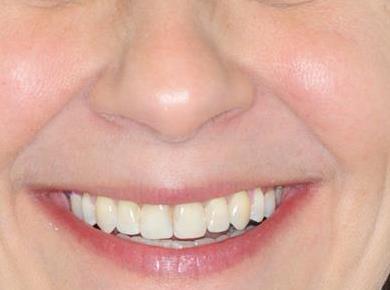 Ali so ortodontski aparati tudi za odrasle?